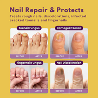 Fungi Free Bee Venom Nail Treatment Solution Serum (15ml)