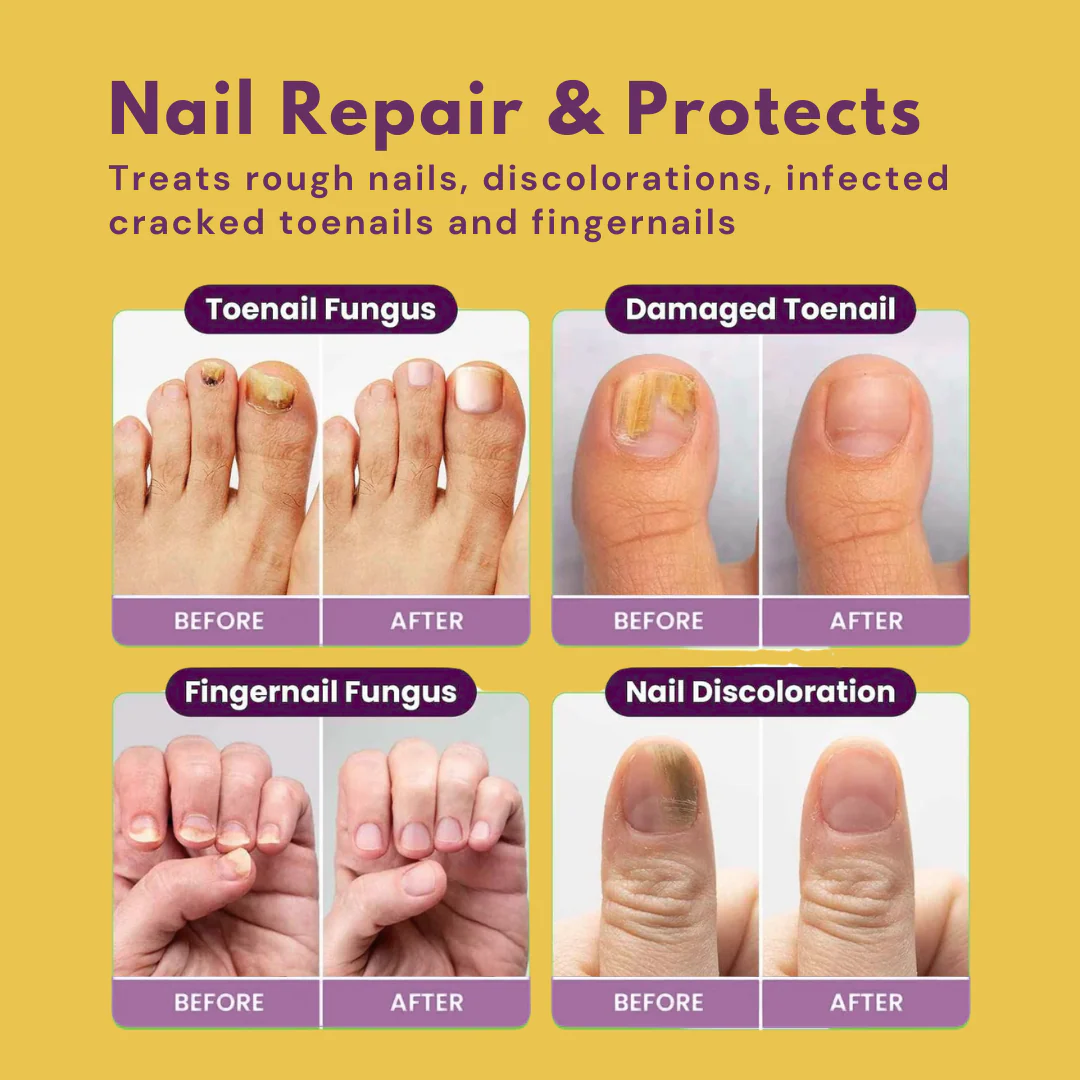 Fungi Free Bee Venom Nail Treatment Solution Serum (15ml)